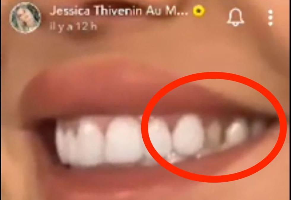 On peut apercevoir la dent cassée de Jessica Thivenin des Marseillais dans sa story Snapchat.